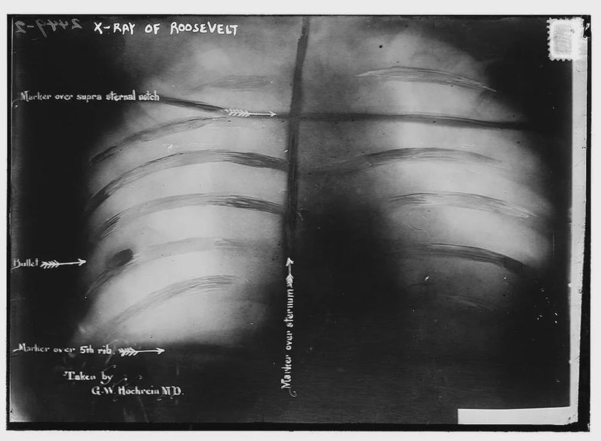 theodore roosevelt assassination attempt - Bullet sprts XRay Of Roosevelt Marker over supra sternal notch Marker over 5th rib Taken by GW. Hochrein Md. Marker over sternum